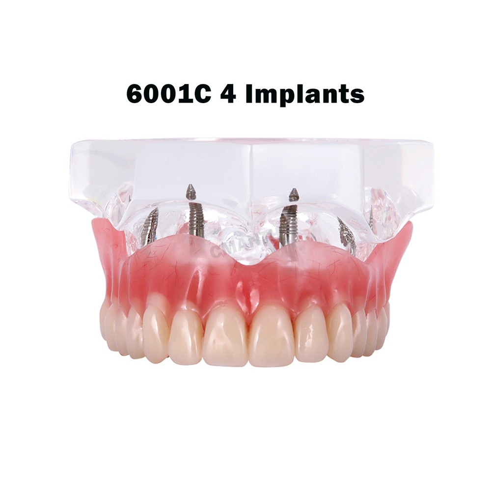 Multiple Types Dental Teeth Model Ortho Implant Pathological Perio Practice Demo