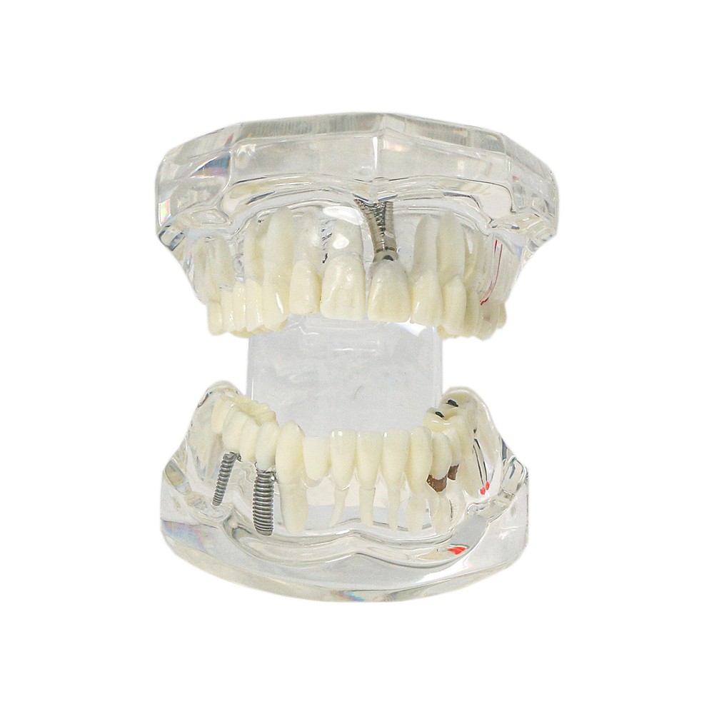 Multi-Type Dental Teaching Typodont Model Ortho/Implant/Pathology Practice Demo