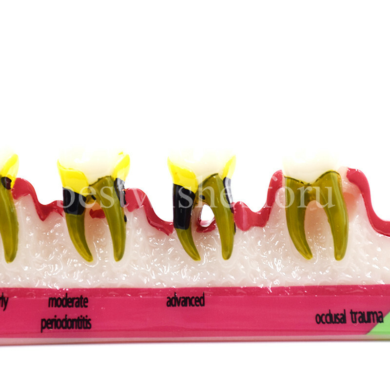 Dental Periodontal Disease Assort Developing Demonstration Teeth Study Model