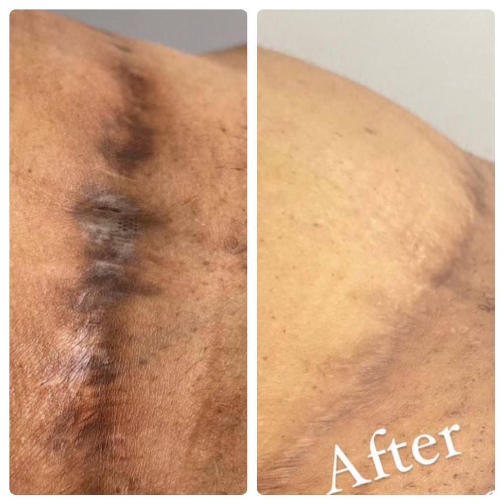 Body Bleaching Cream Max Strength Whitening Lightening AHA