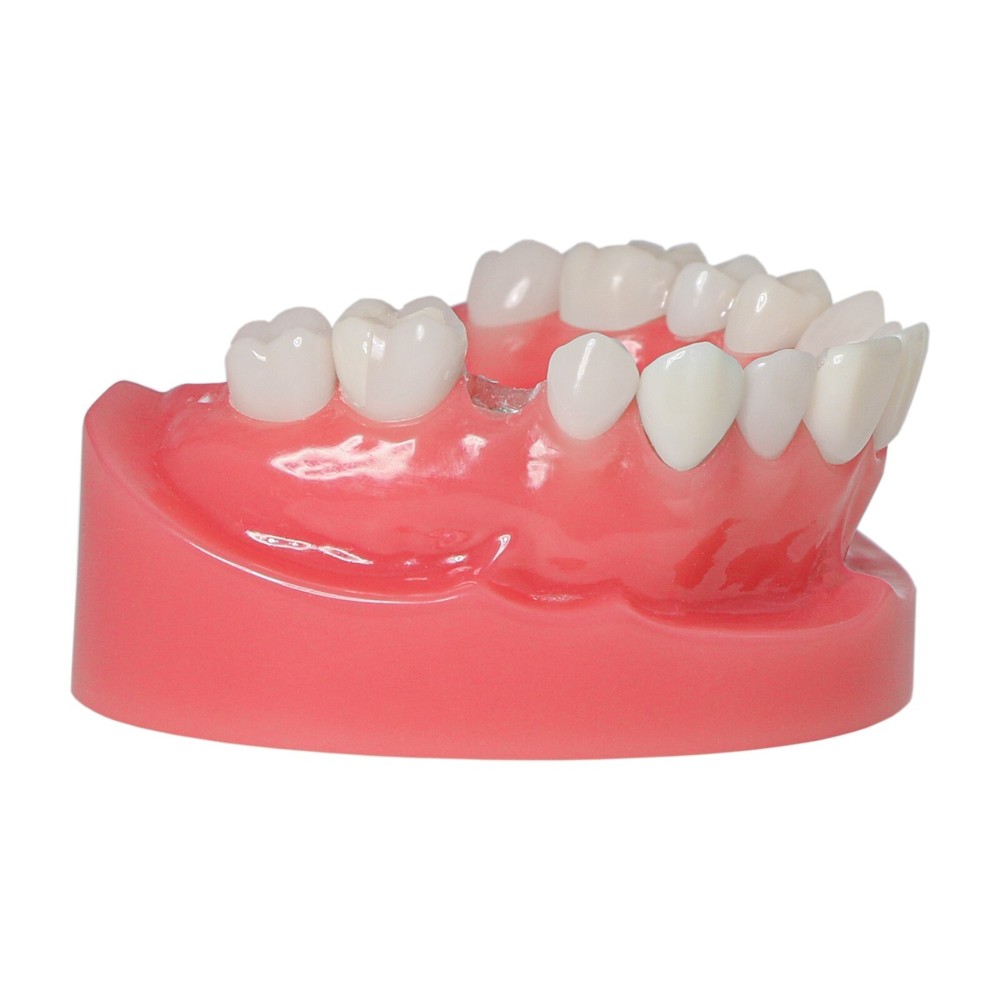 Dental Implant Disease Teeth Model Overdenture Implants Upper/Lower Demo