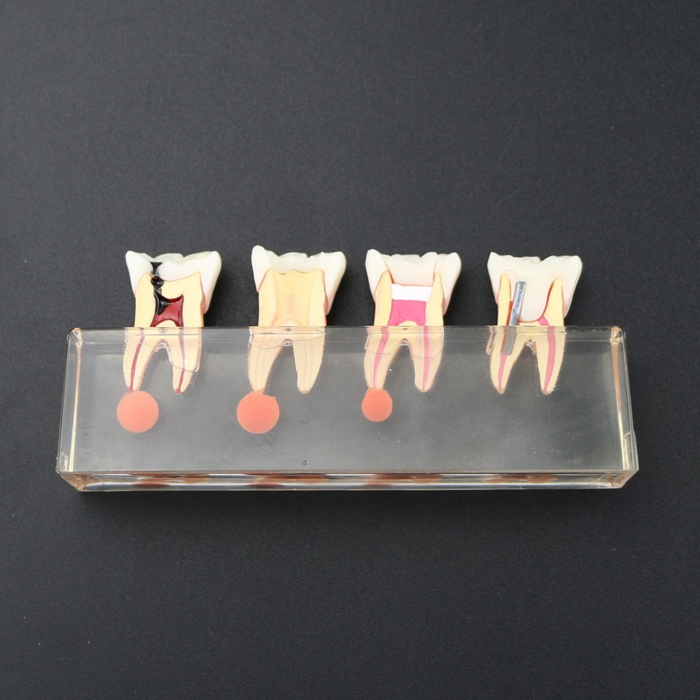 1 Set Dental Teeth Model #4018 01 - 4-Stage Endodontic Treatment Study Model