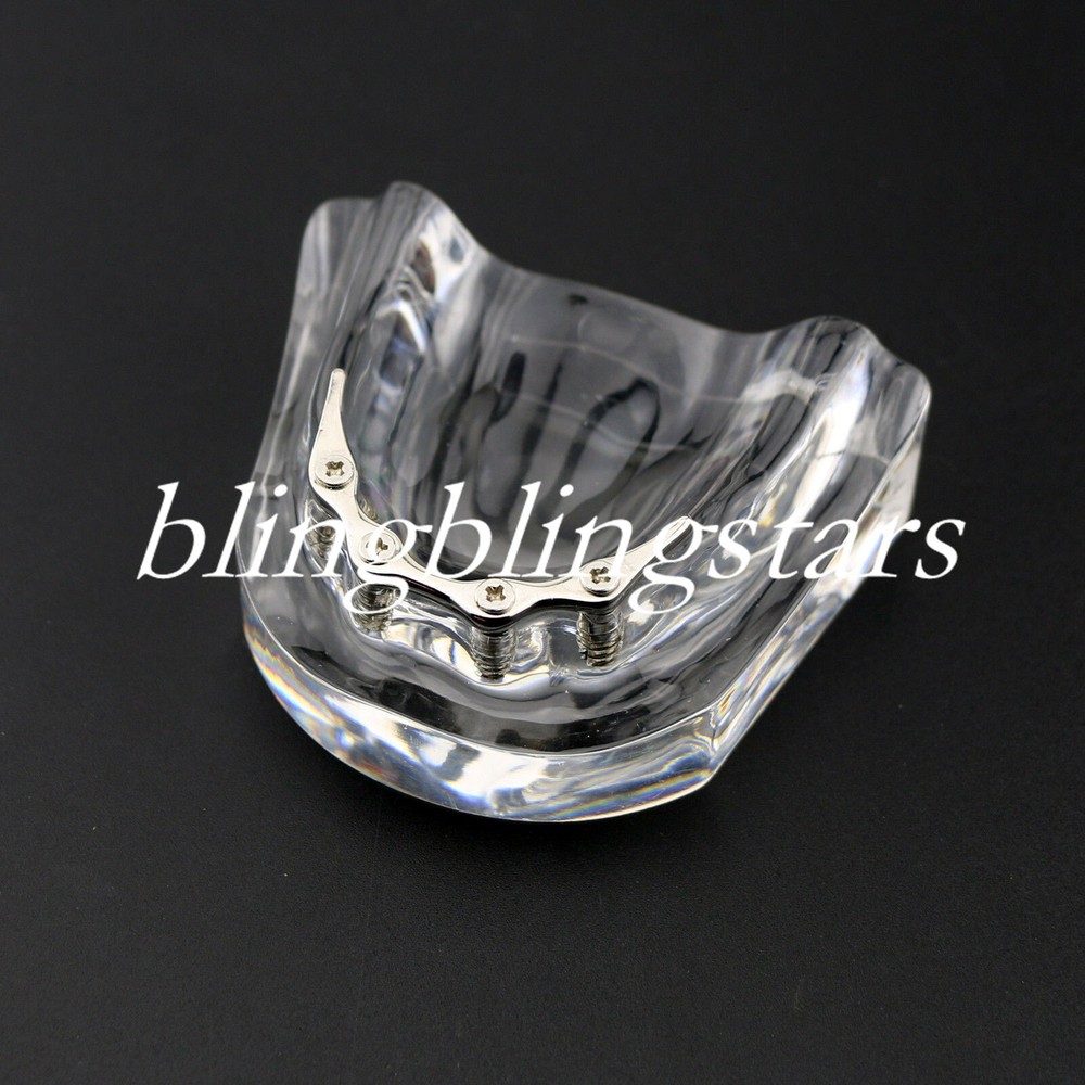 Dental Overdenture Restoration Typodont Implant Teeth Model Silver Bar