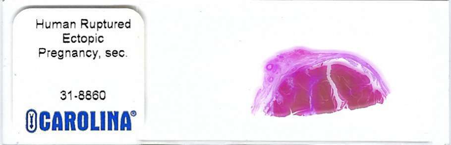 Human Ruptured Ectopic Pregnancy Pathology Microscope Slide