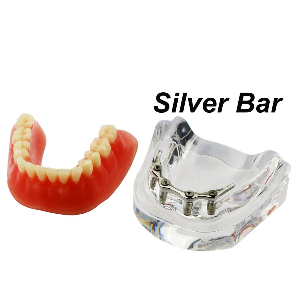 Detal Typondont Implant Teeth Model 4 Implants With Silver Golden Bar