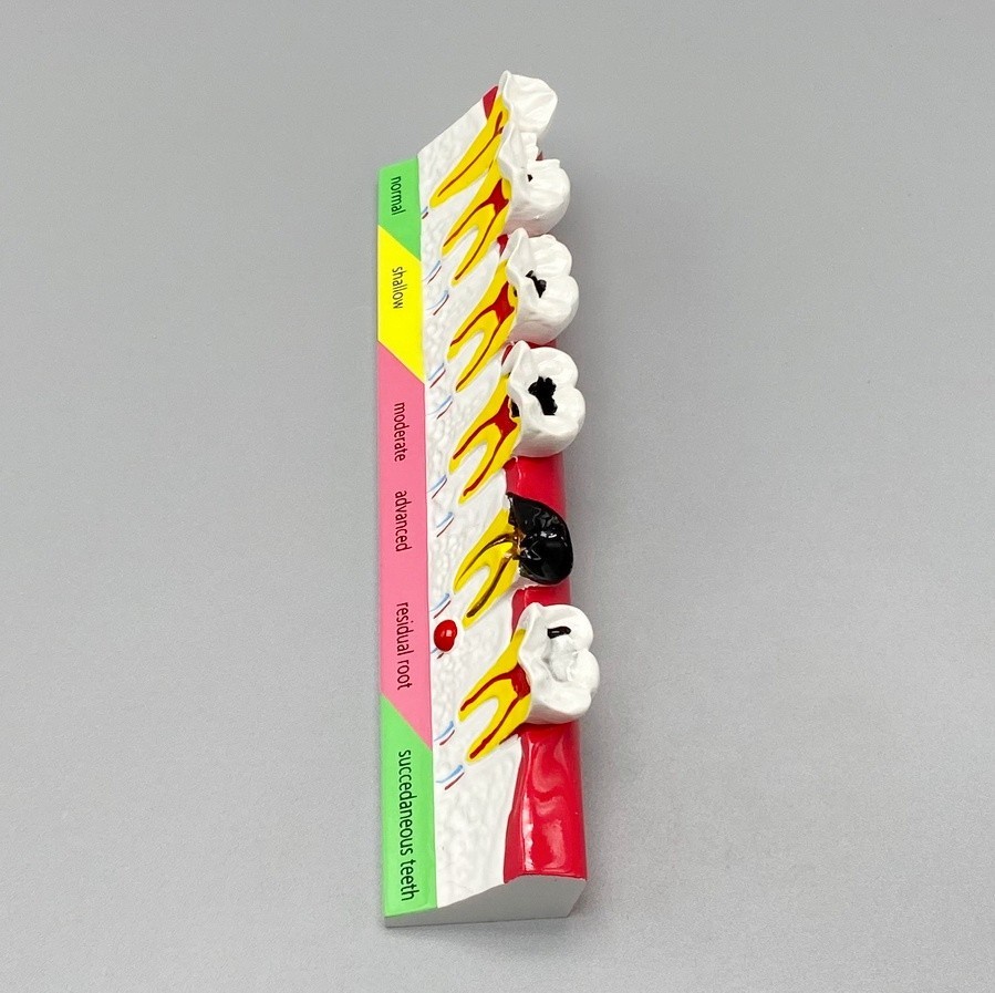 Dental Caries Disease Models Dentoform Typodont Study Teaching Teeth Model Demo
