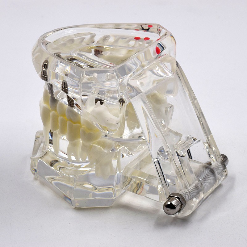 Dental Removable Restoration &Implant Pathological Disease Teeth Study Model