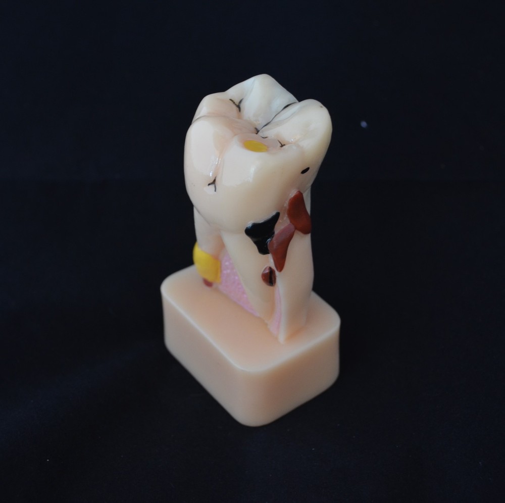 Dental Model #4044 01 ( #4015 02 )- 4:1 Molar Pathological Study Model