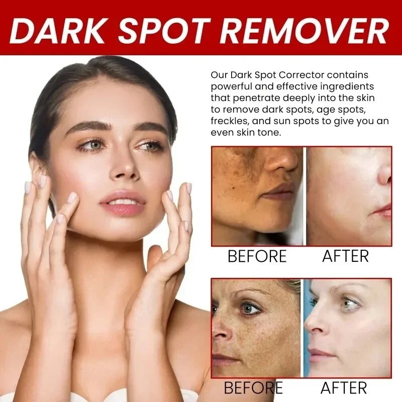 Powerful Spot-removing Whiten Cream Pigmentation Melasma Dark Spots