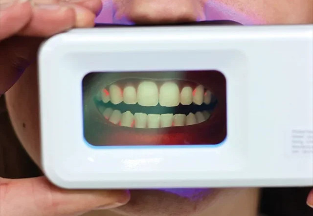 QScan Plus-UV plaque Screening Device