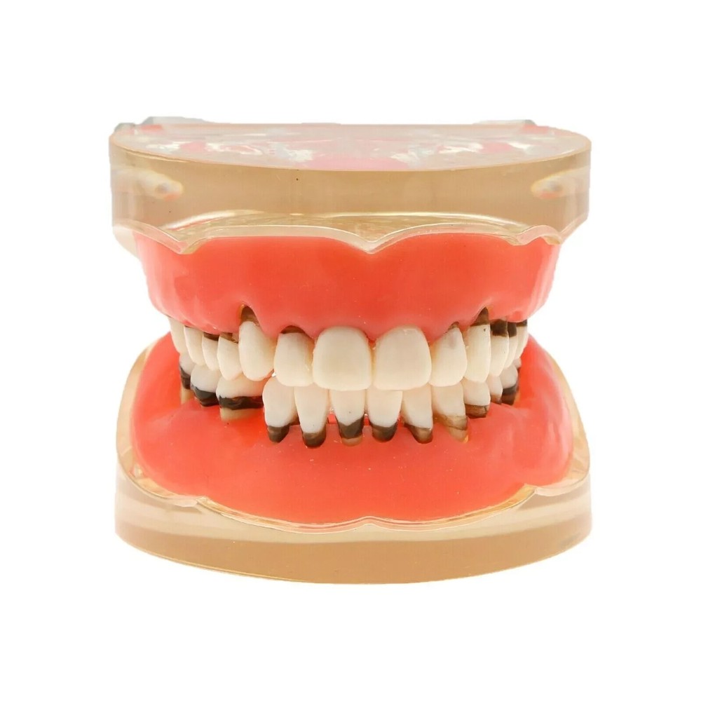 Dental Teeth Model Pathological Disease M4017 Removable Teaching Study Model