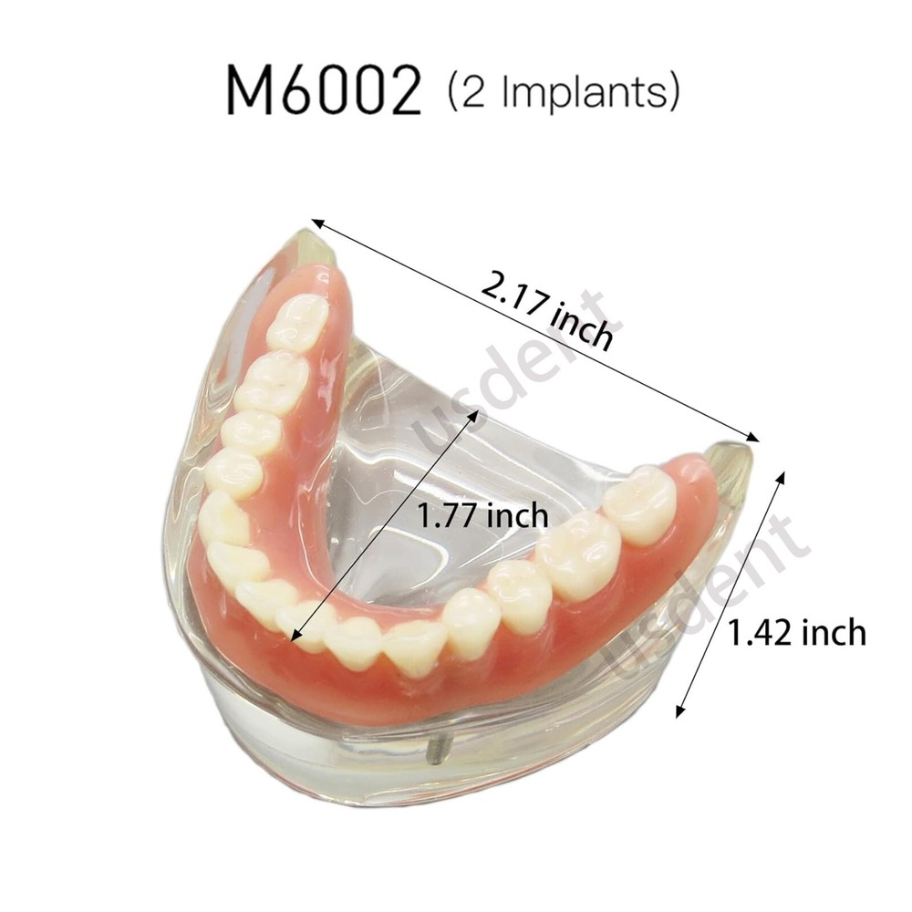 Dental Implant With 2 Implants Teeth Demo Model Overdenture Restoration Model