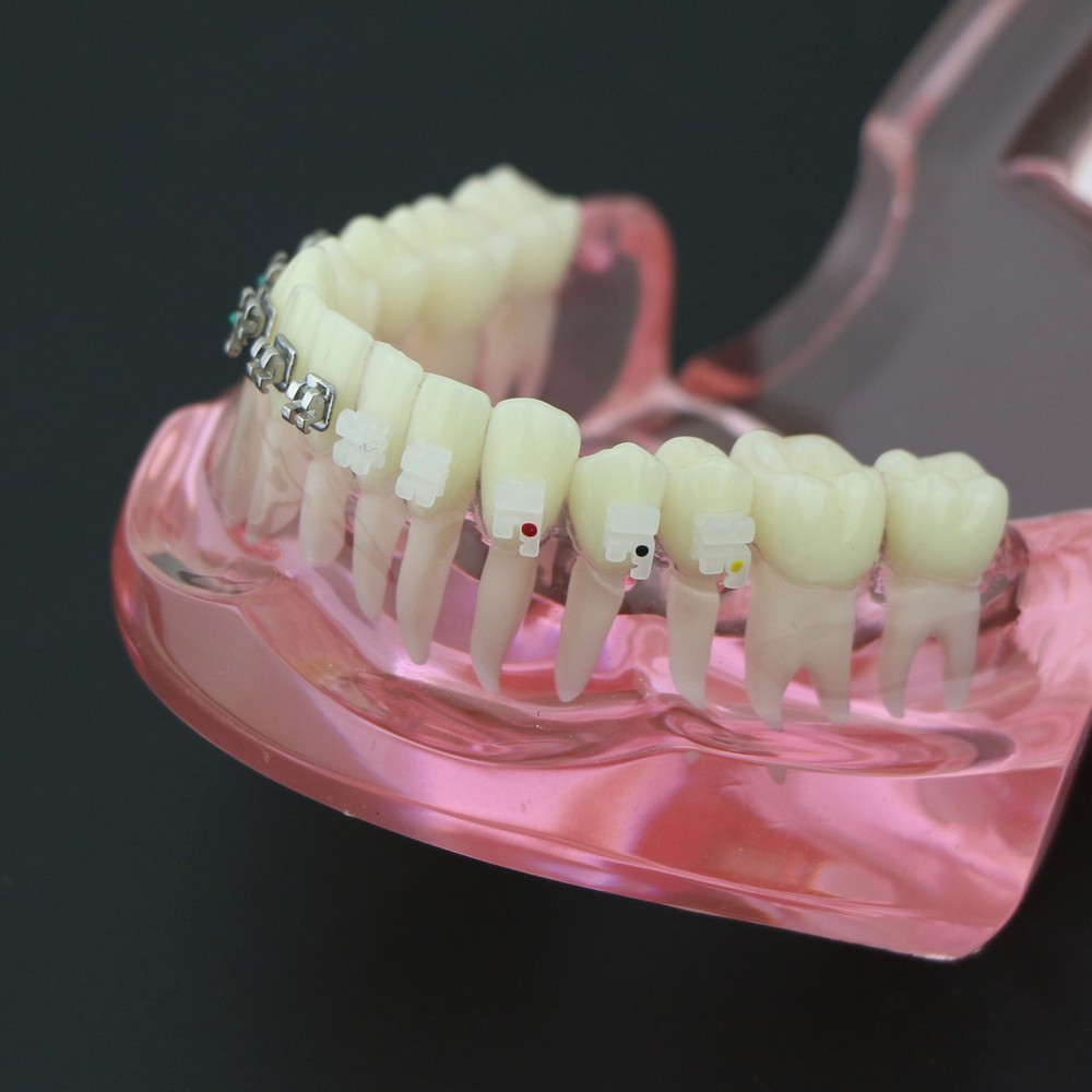 Dental Orthodontic Teeth Model Metal and Ceramic Bracket Study Teach Model 3003