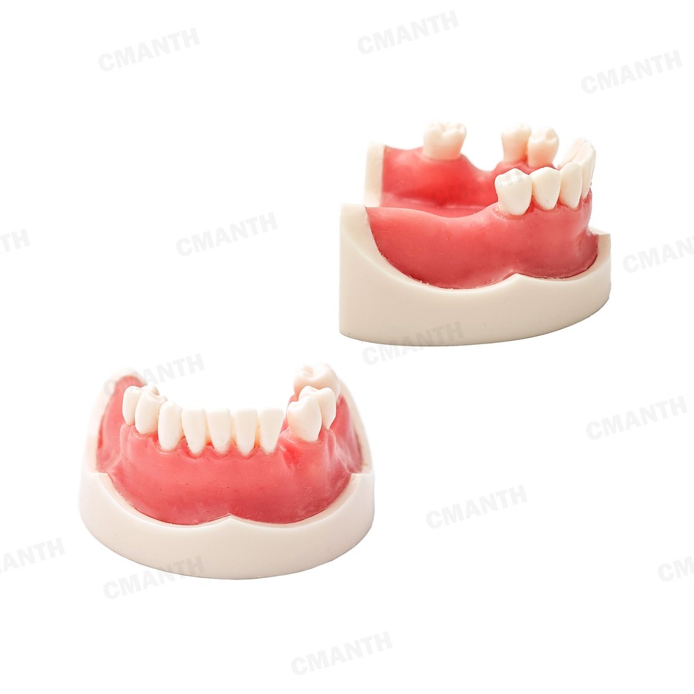 US Dental Teeth Implant Model Soft Gums Model Drilling Open Suture Practice