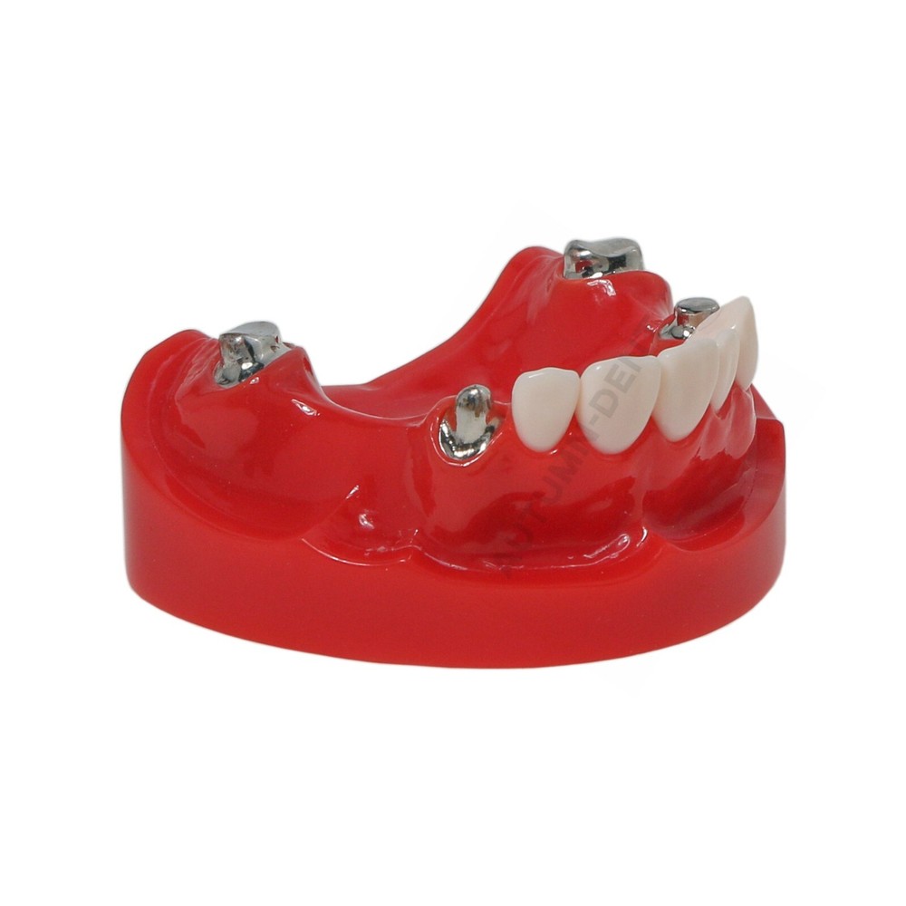 Dental Overdenture Typodont Teeth Model Telescope Crown Prosthetics Model M6010