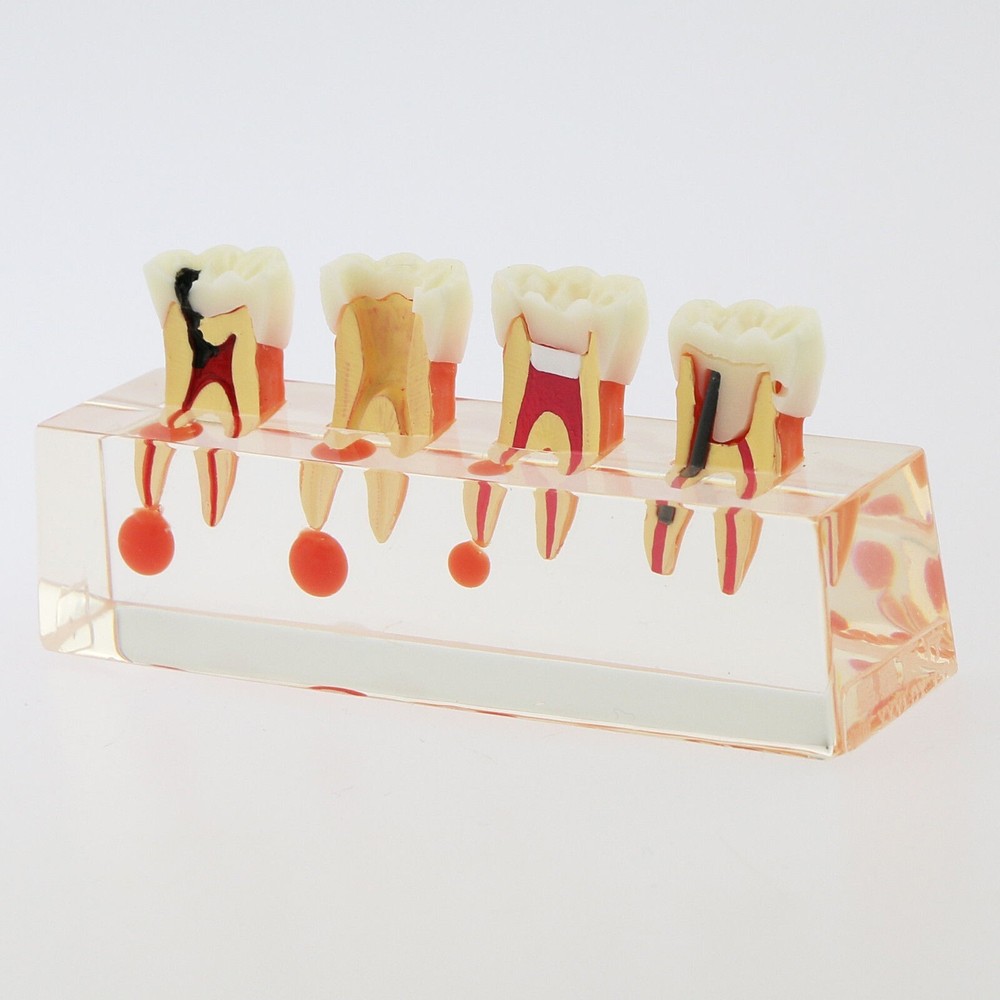 1 Pcs Dental 4 Stage Endodontic Treatment Study Teaching Typodont Teeth Model