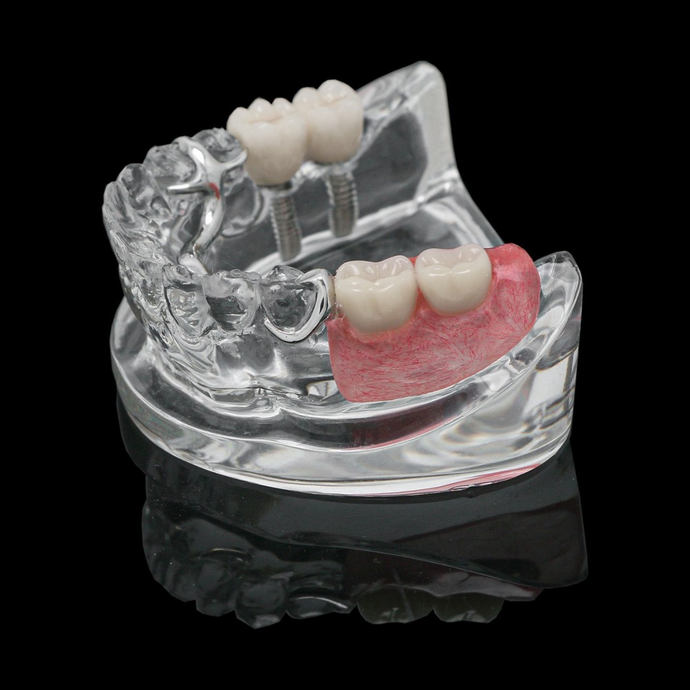 Dental Training Typodont Model with Removable Partial Denture Teaching Model