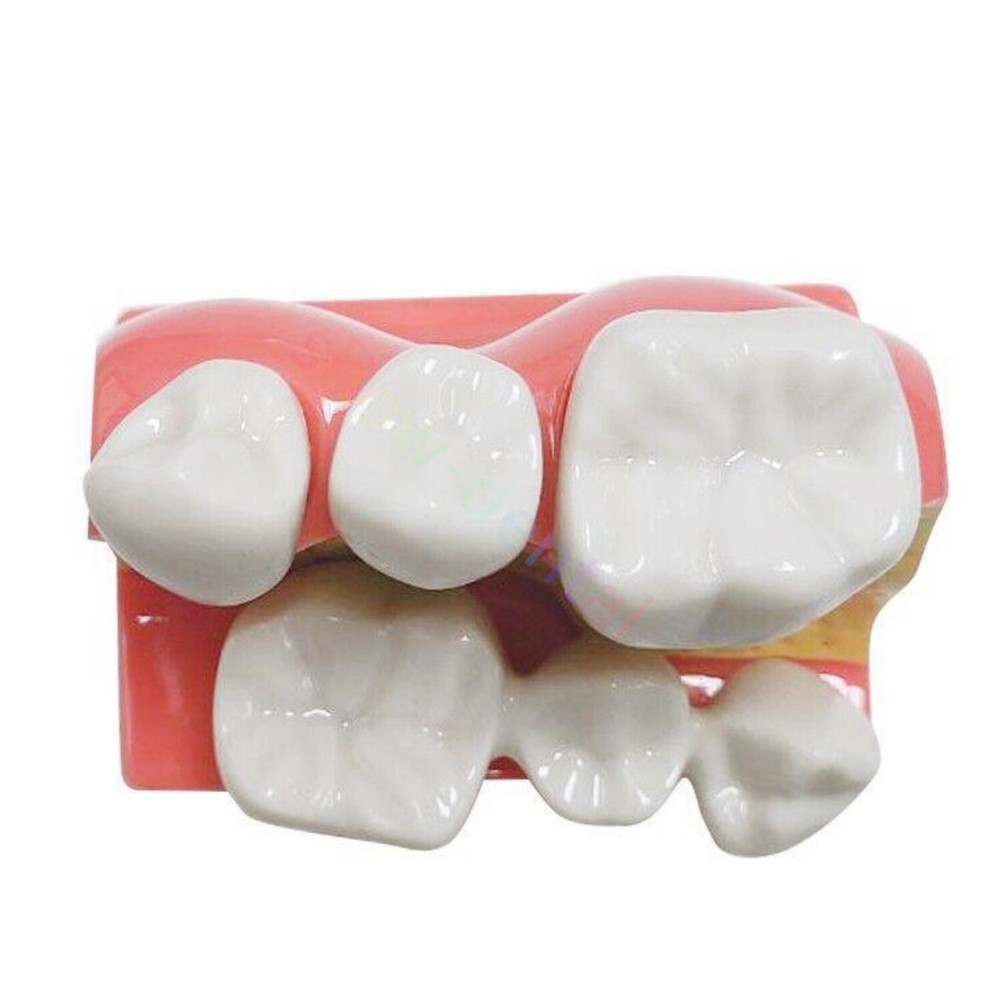 Dental Implant Analysis Removable Crown Teeth Model Analysis Study Model