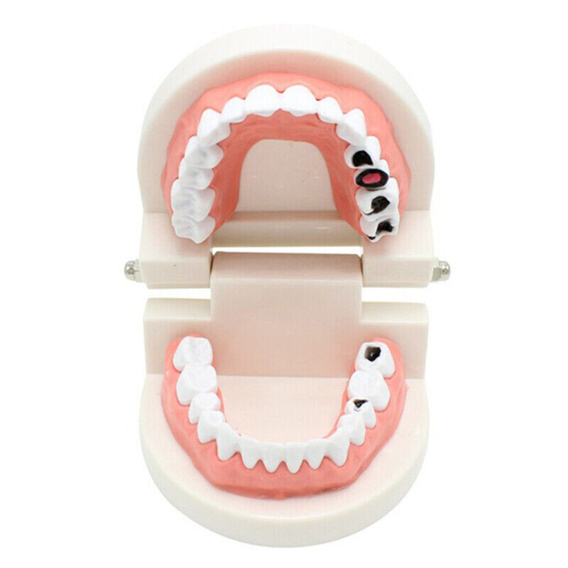 Dental Demonstration Adult Caries Model Decay Standard Study Teeth Teach Model