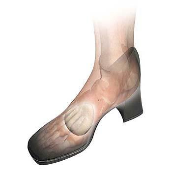 Hapad Metatarsal Cook-ies