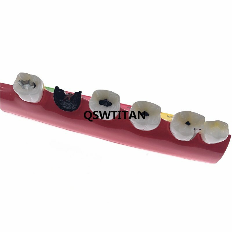 Dental Caries Classify/Evolution model Tooth Model Dental Study Model