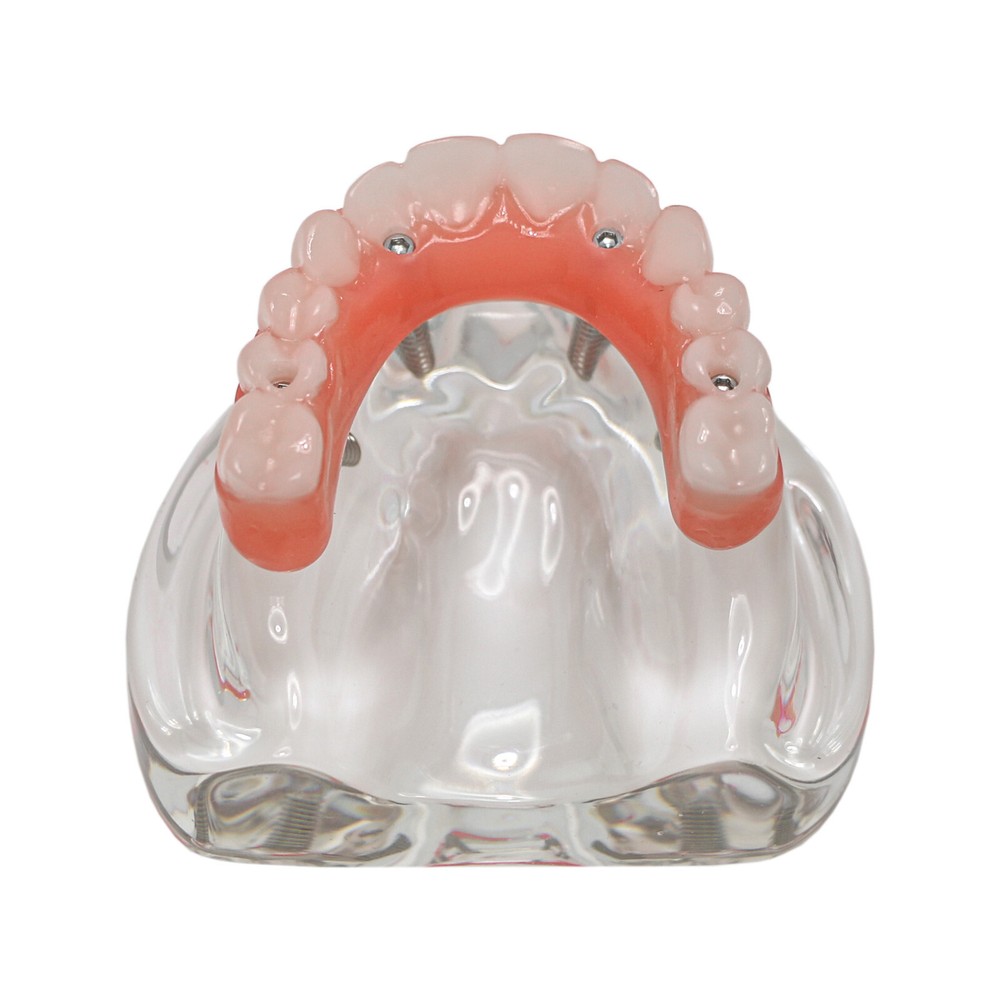 Dental Implant Model PRD Removable Partial Dentures Overdenture treatment Model