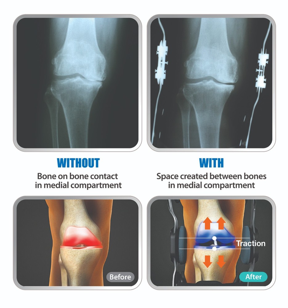 DDS OA PRO Decompression Knee Brace (Dual Unloader)
