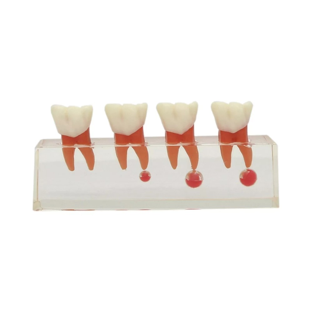 Dental Endodontic Treatment Study Teaching Typodont Teeth 4018 Model 4 Stage