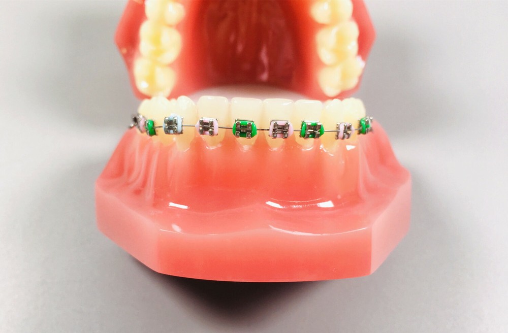 1Pc Dental Model Invisible Retainer Metal Brackets Contrast Aligner Comparison