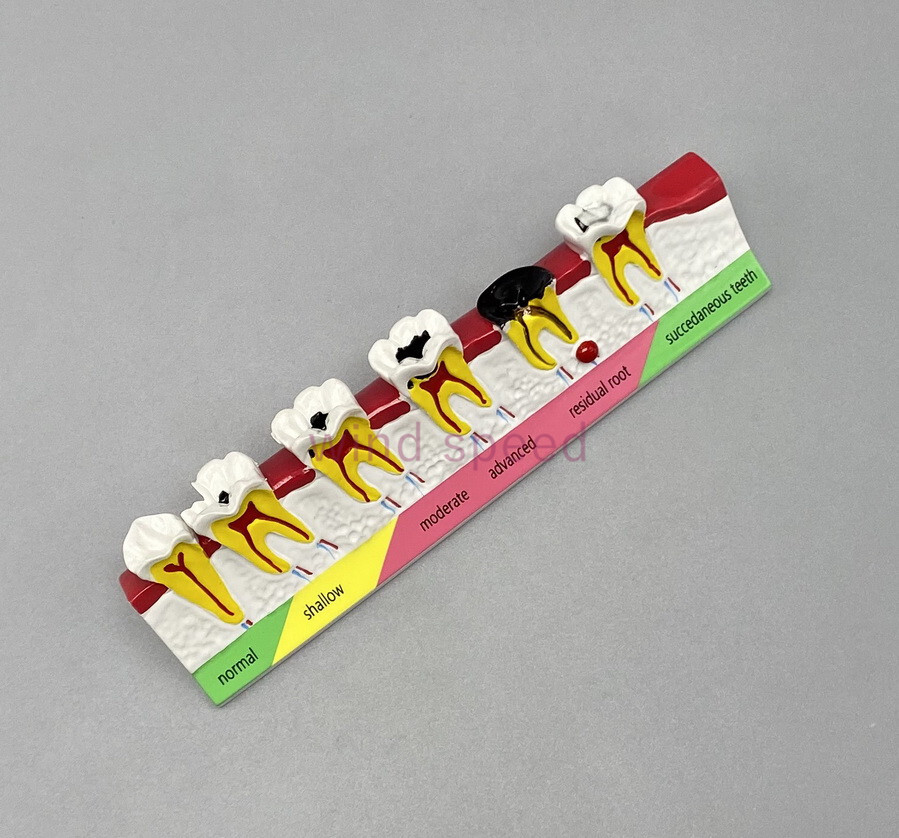 Dental Teeth Dentoform Typodont Caries Periodontal Disease Study Teaching Model