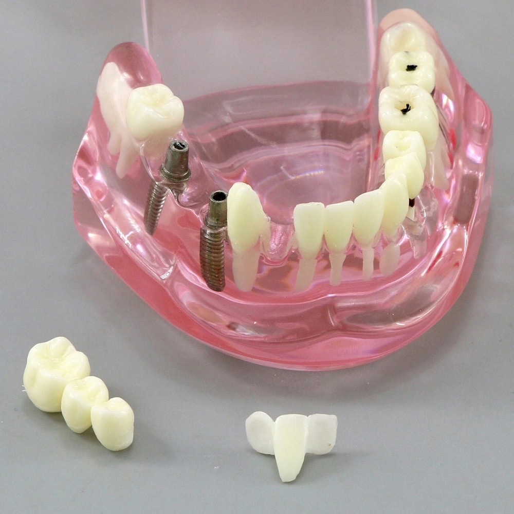 Dental Teeth Model Multiple Types Ortho Implant Practice Teaching Demo Model