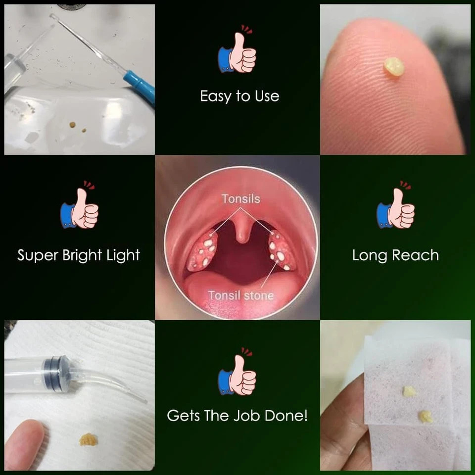 Upgraded 2 Lighted Tonsil Stone Remove Tool Tonsillolith Pick + Irrigation Clean