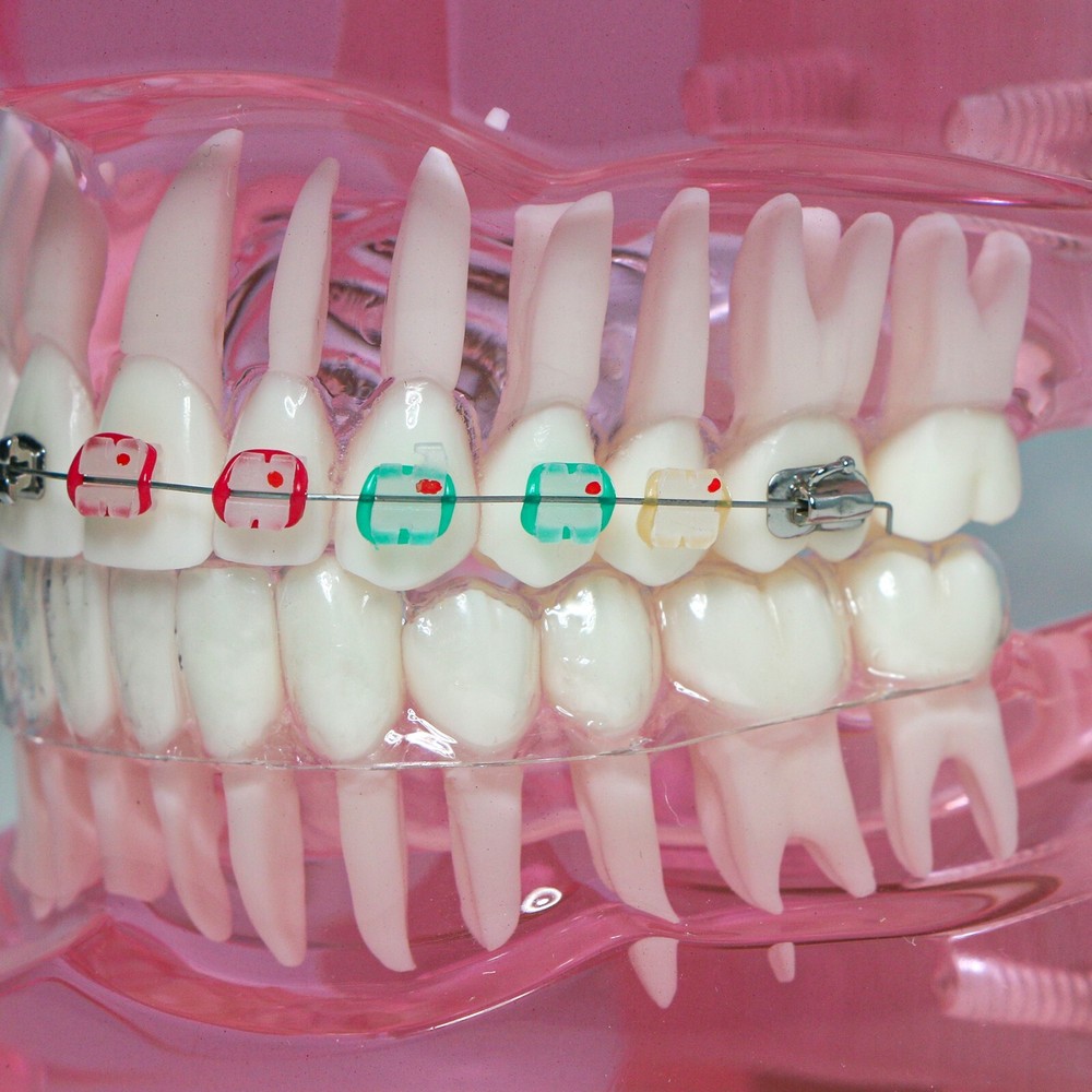 Dental Ortho Study Teach Teeth Model With Ceramic & Metal Brackets M3012 Pink