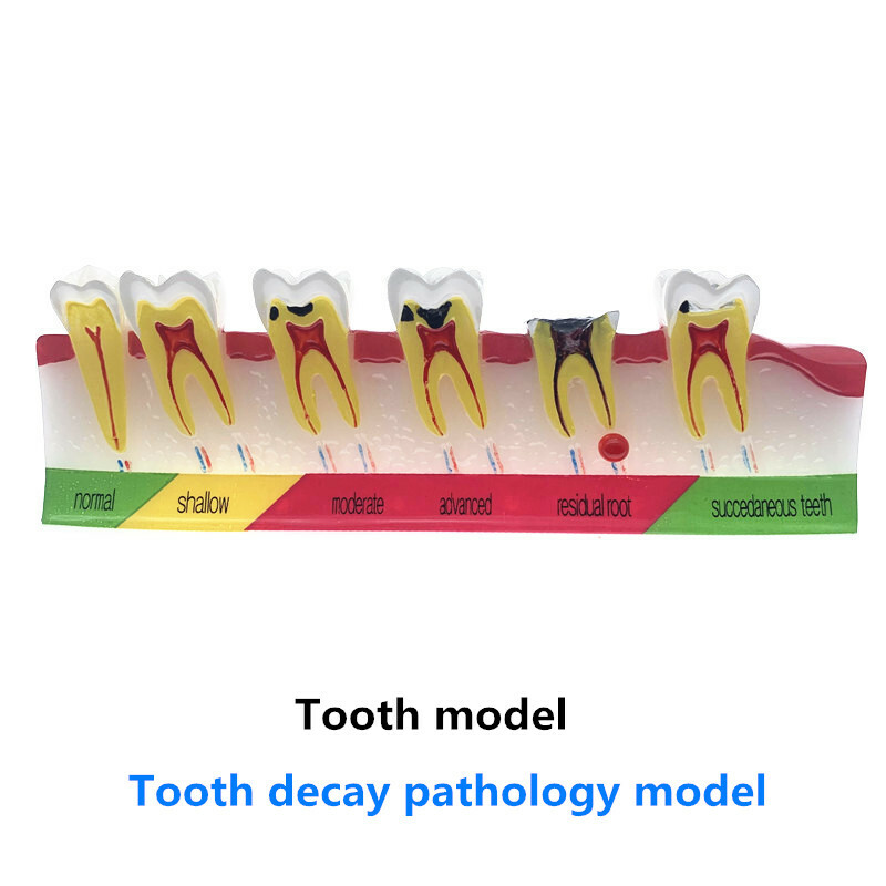 Dental Caries Classify/Evolution model Tooth Model Dental Study Model