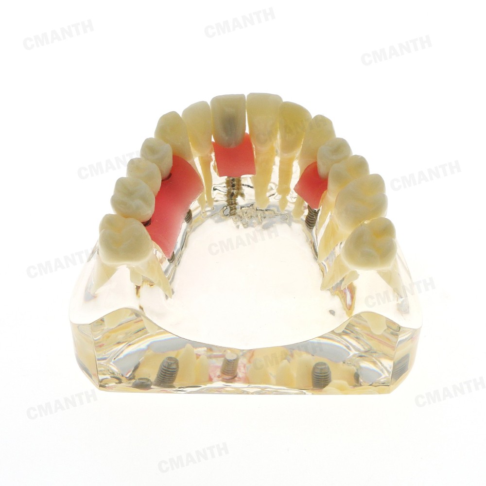 Dental Teeth Pathological Perio Practice Implant Model Studying Teaching M2005