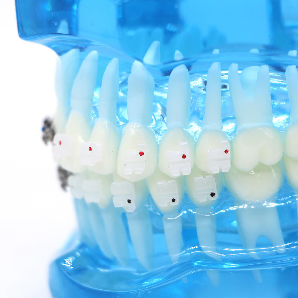 Dental Orthodontic Study Model with Metal & Ceramic Brackets for Teaching