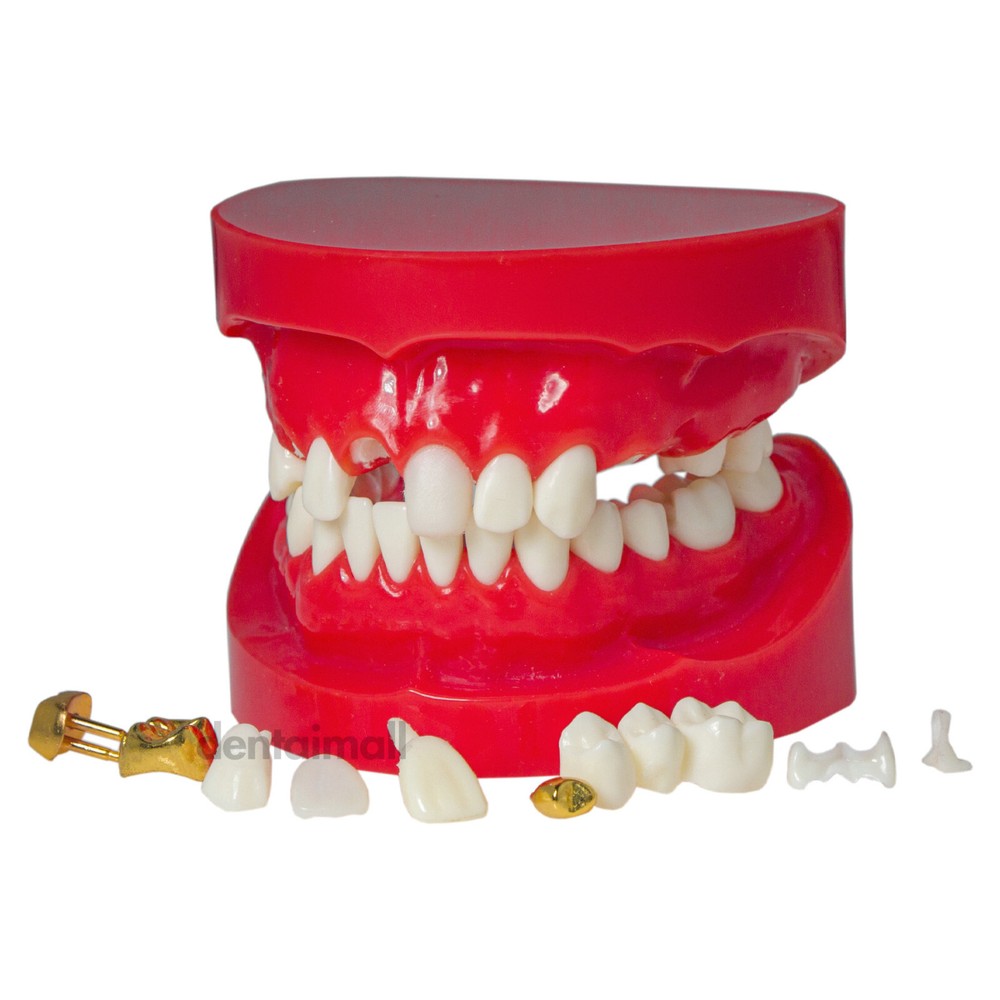 Dental Teeth Crown Restoration Model with Post Core Bridge for Teaching M6004