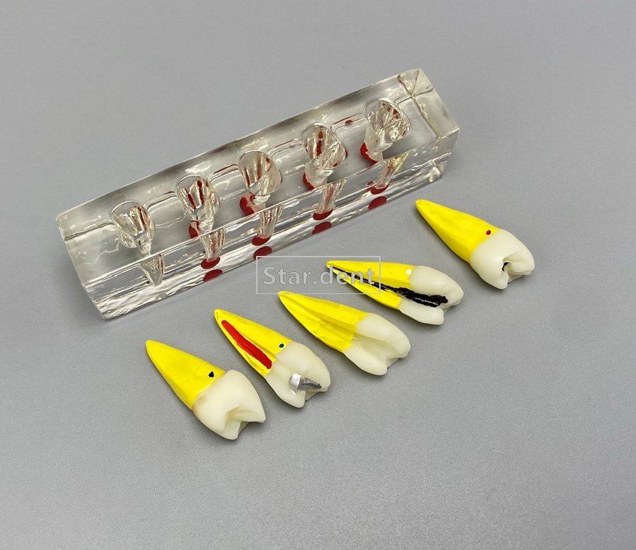 Dental Caries Teeth Model Detachable Abutment Teaching Study Models 4 times