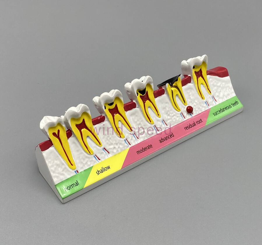 Dental Teeth Dentoform Typodont Caries Periodontal Disease Study Teaching Model