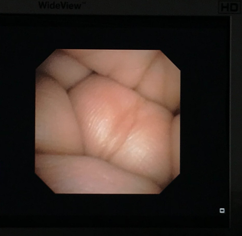 BF-P190 Bronchoscope Endoscope Endoscopy (4572-s207)