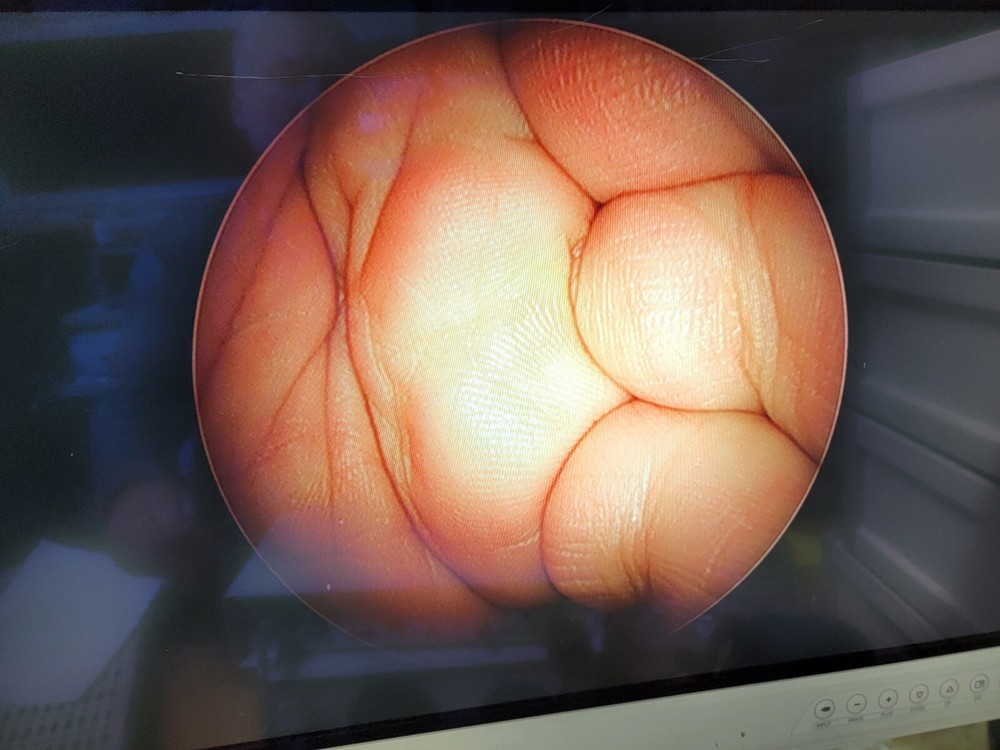 Dyonics Carpal Tunnel Set w/ 30° Scope