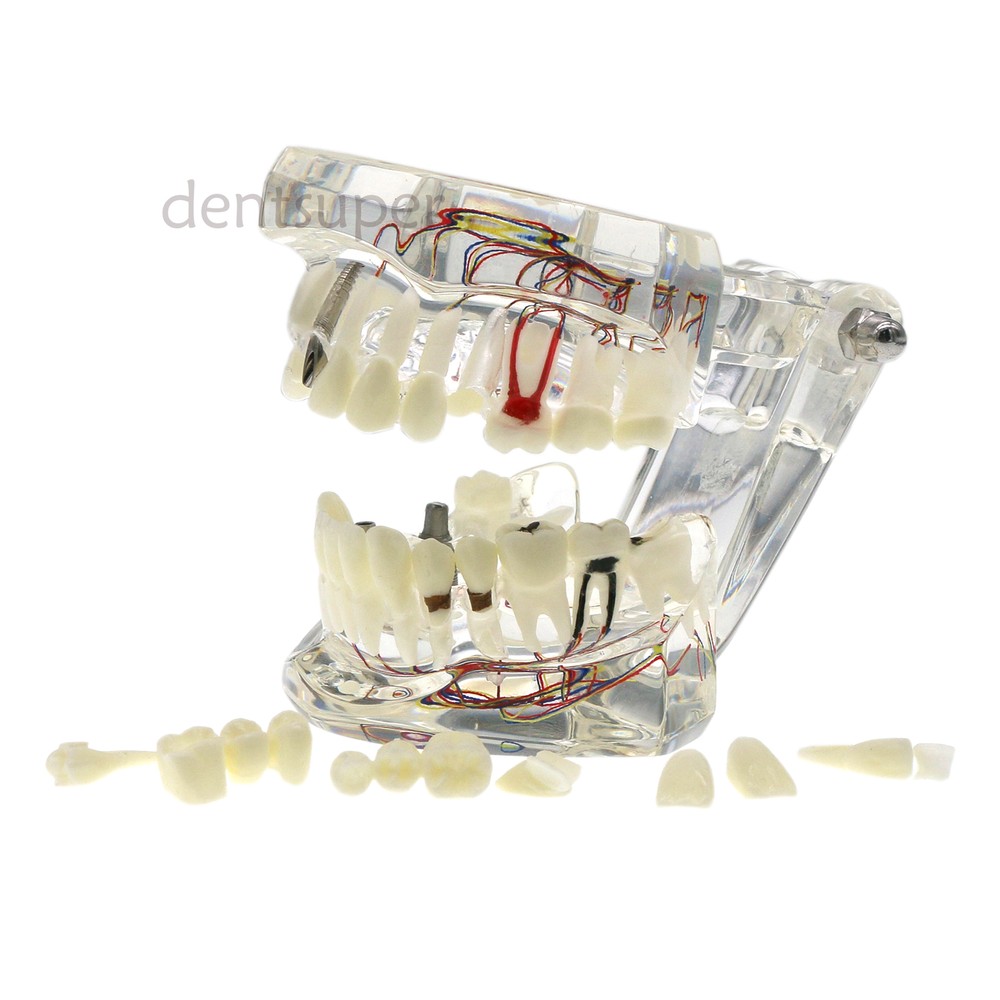 Dental Multiple Types Teaching Teeth Model Typodont Ortho Implant Practice Demo