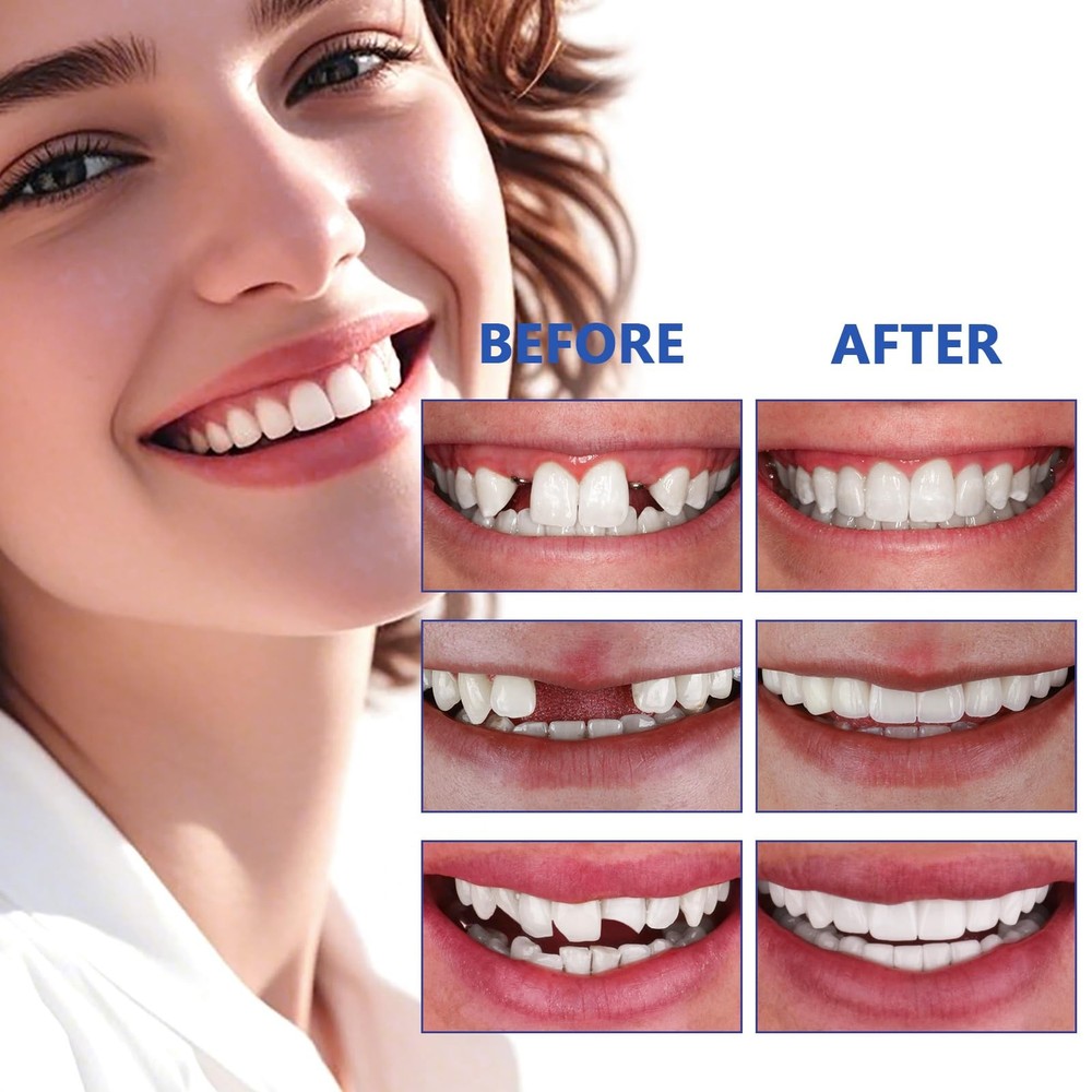 Tooth Repair Kit, Moldable False Teeth, Tooth Replacement Missing Teeth, Teeth