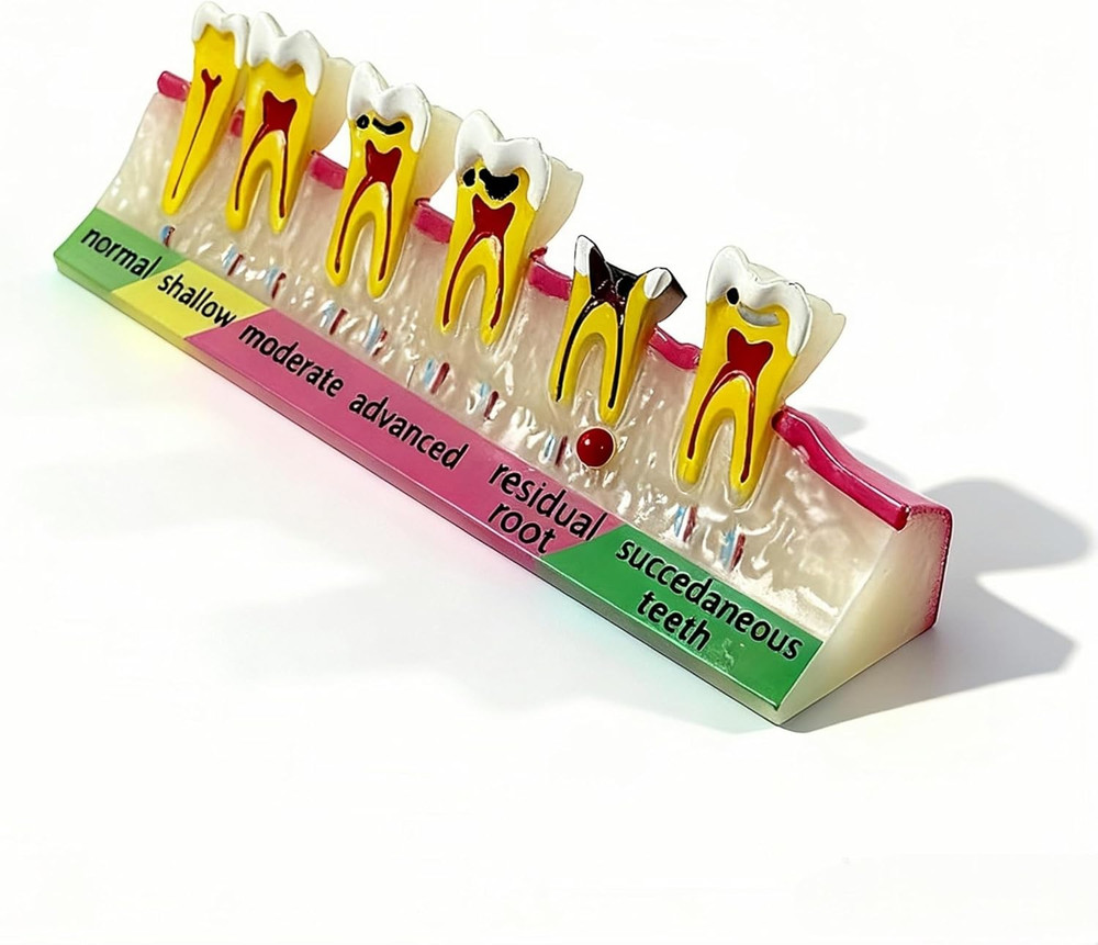 6-Stage Dental Caries Development Model - Anatomical Teeth Decay Demonstration w