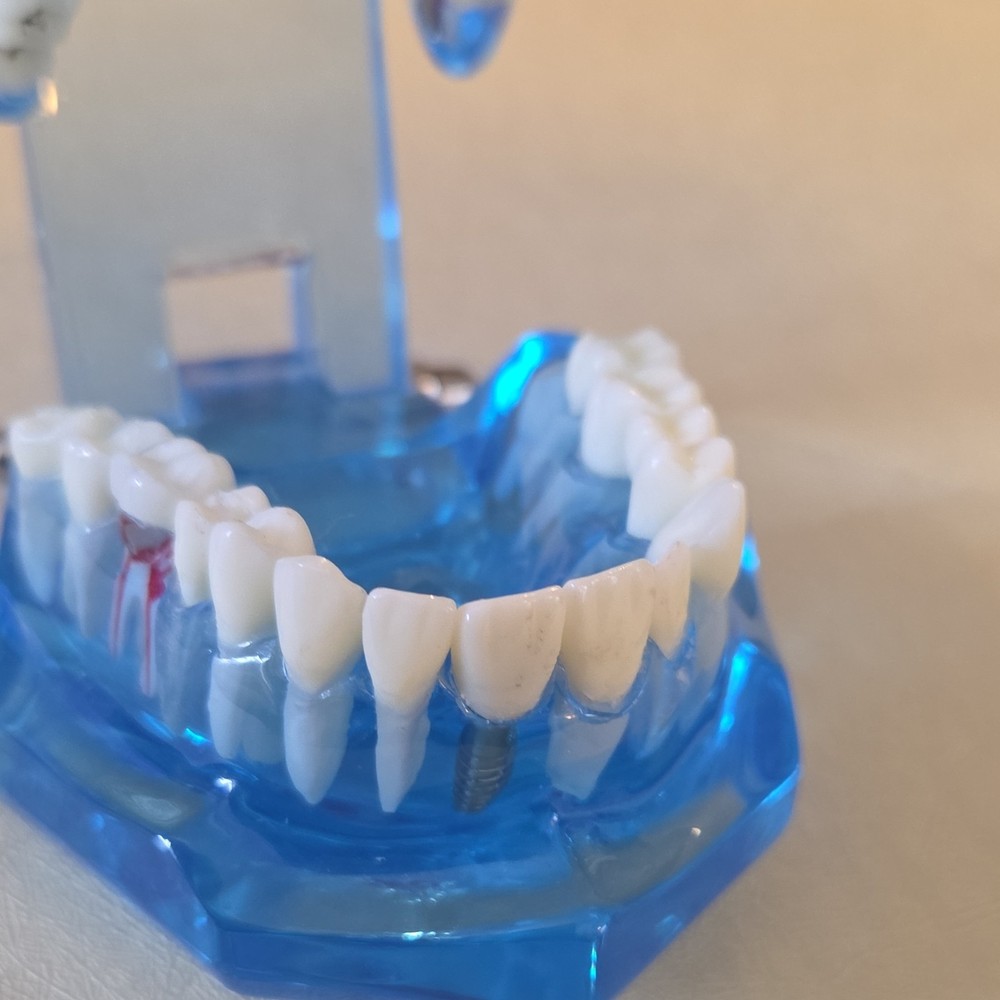 Typodont Dental Model with Removable Teeth, Implants, Blue Transparent Base