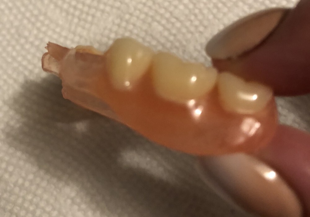 BURBANK Replacement DentalLab Partials Lower Side 6 teeth CustomMadeMissingTooth