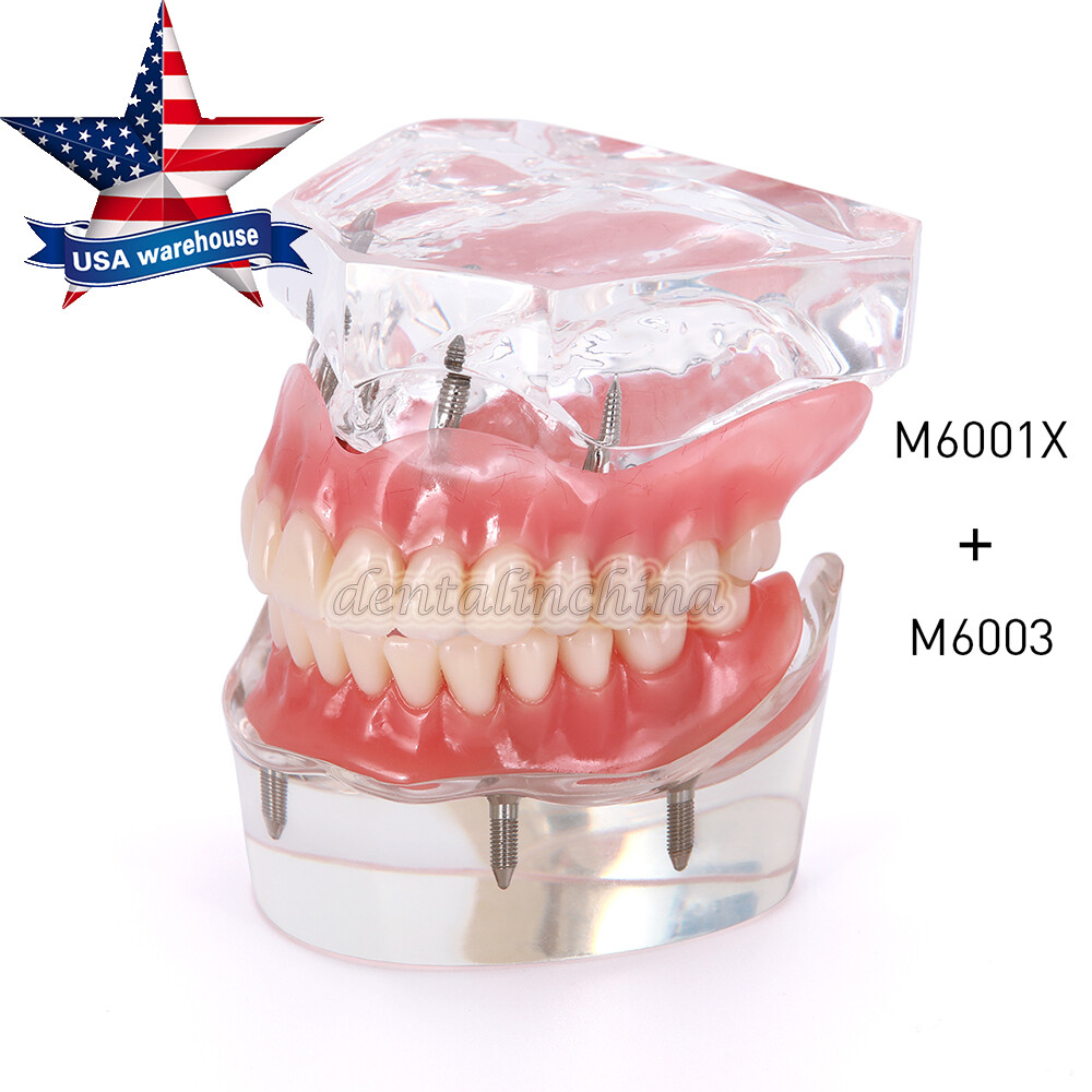 Dental Implant Teach Study Model Demo Overdenture Typodont 4Implants Upper Lower
