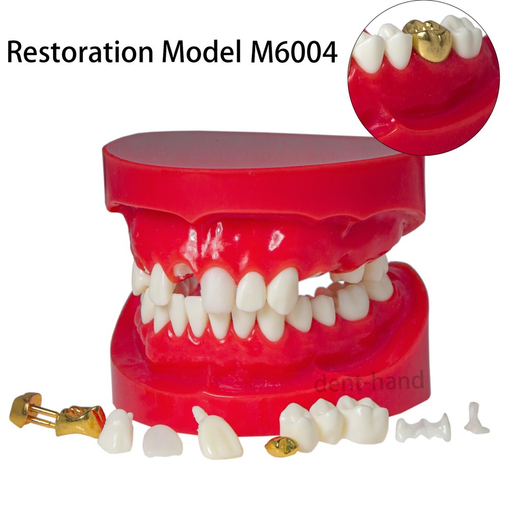 Dental Typodont Teeth Model Restoration Crown with Post Core Bridge M6004