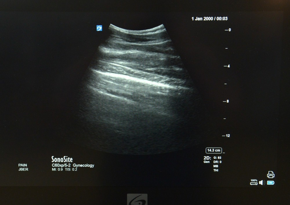 FujiFilm SonoSite X-Porte C60xp/5-2 MHz Curved Array P14561-20
