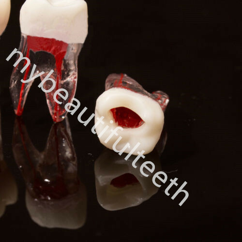 Dental Tooth Endo Root Canal Study Model RCT Practice Block Pulp Cavity